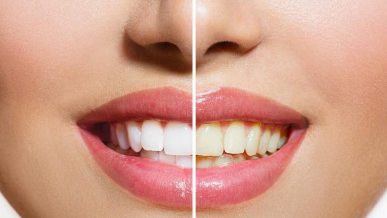 Flavorful Smiles: Benefits of Having Flavors in Whitening Teeth Strips